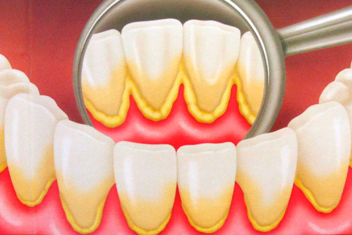 Acumulación de placa dental