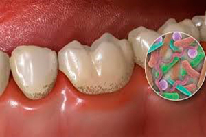 Acumulación de Placa Dental
