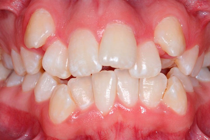 Apiñamiento Dental