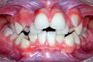 Apiñamiento Dental
