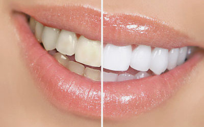 Blanqueamiento Dental