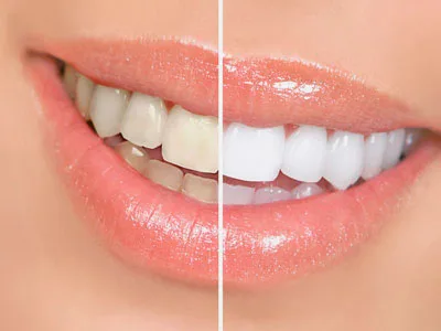 Blanqueamiento Dental