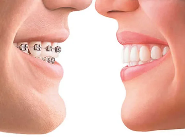 Brackets Metálicos Ortodoncia