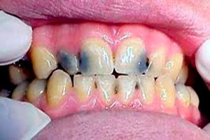 Caries Profunda