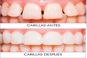 CARILLAS