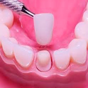 CORONAS-DENTALES2