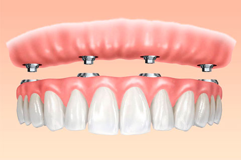 protesis dental fija sobre implantes dentales