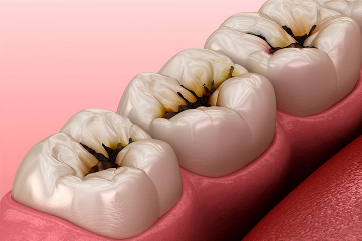 Caries Dental