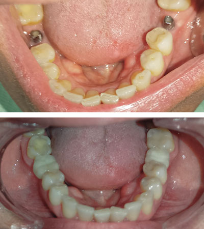 Caso Clínico Real de un Implante