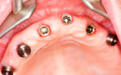 ¿Cómo se colocan los implantes dentales?