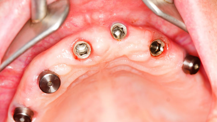 ¿Cómo se colocan los implantes dentales?