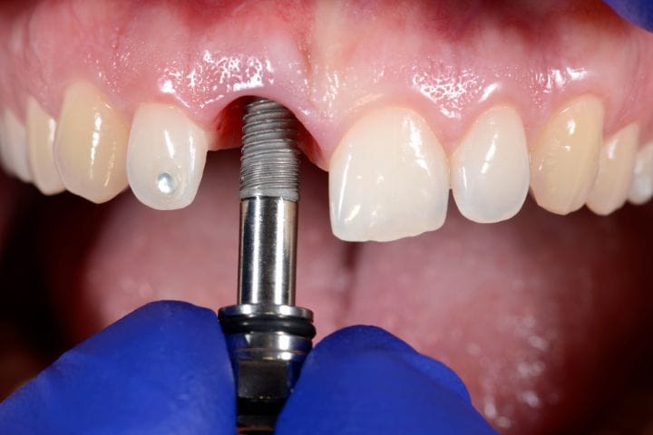 Cómo cuidar tus implantes dentales para que duren muchos años