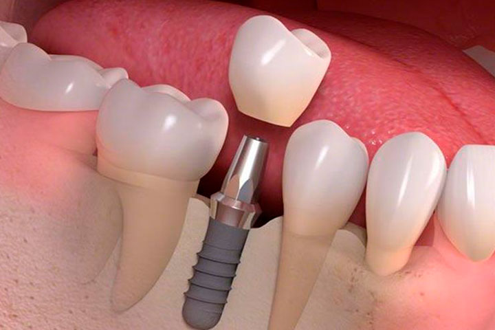 Cuanto dura un Implante Dental