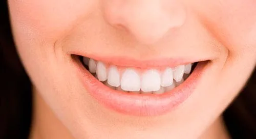 Carillas Dentales
