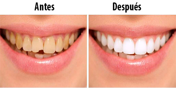 Diseño de Sonrisa