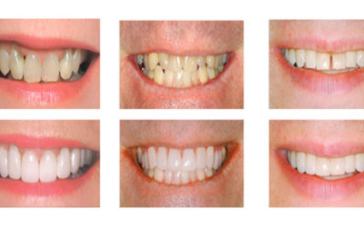 Diseño de Sonrisa