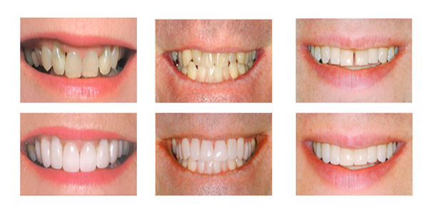 Diseño de Sonrisa