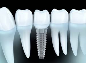 ¿Cuanto tiempo duran los Implantes Dentales?