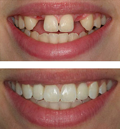 Implantes Dentales Ejemplo Implantes Dentales Ejemplo