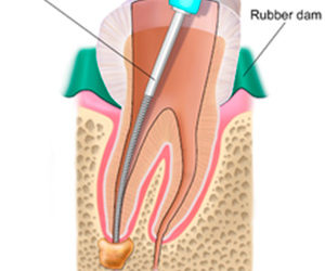 Endodoncia