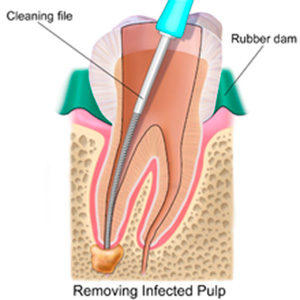 Endodoncia3