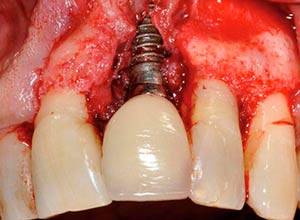 ¿Cuales son las causas de la periimplantitis?