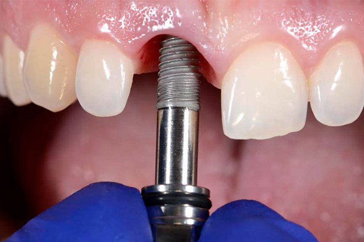 Implante dental