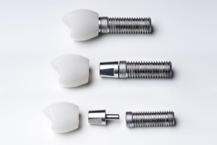 Tipos de Implantes Dentales