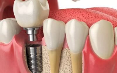 Características y ventajas de un Implante Dental