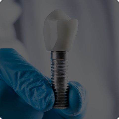 Implantes Dentales Tratamientos