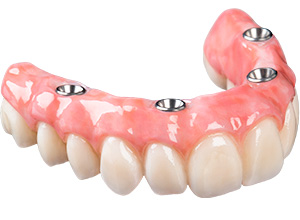 Implantes Dentales All on Four