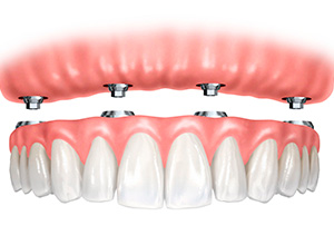 Implantes Dentales All on Four