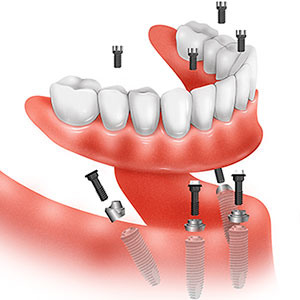 Implantes Dentales All on Four