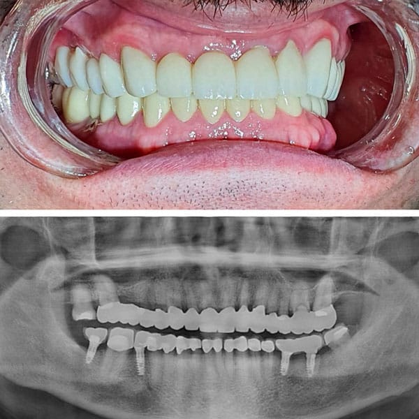 Implantes Dentales Después