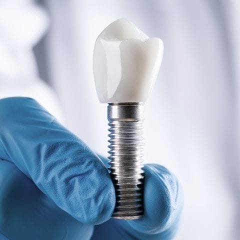 Implantes Dentales que son