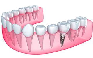 Implantes Dentales Implantes Dentales Dr. Ricardo Molina Moguel