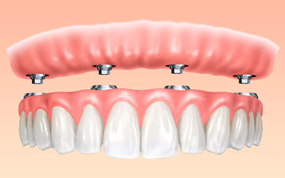 periscopio Cambio Confundir Cuánto cuesta un Implante Dental? | DR. RICARDO MOLINA