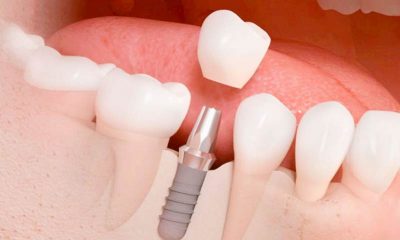 Implante dental más corona