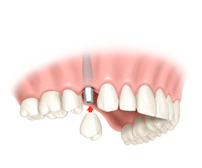 Implante Dental