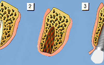Implantes Dentales Inmediatos