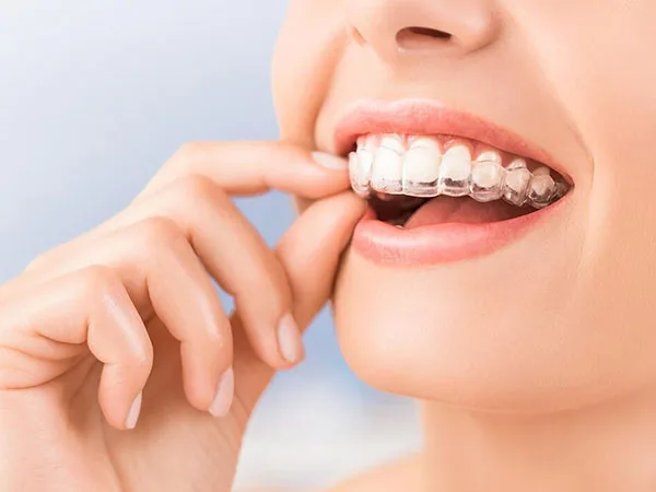Invisalign EsteticImplant