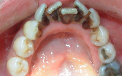 Limpieza Dental