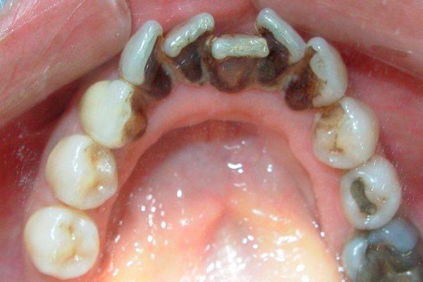 Limpieza Dental