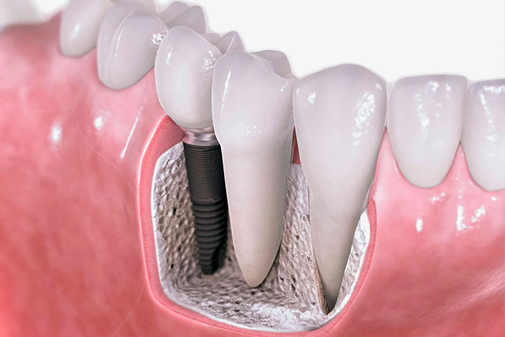 Mitos sobre Implantes Dentales