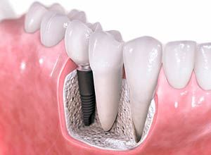 Mitos sobre Implantes Dentales