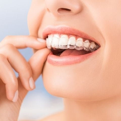 Ortodoncia Invisible Invisalign