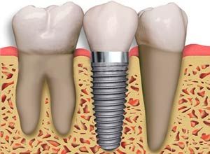 ¿Qué es la Osteointegración?