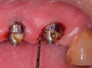 ¿Qué es la periimplantitis?