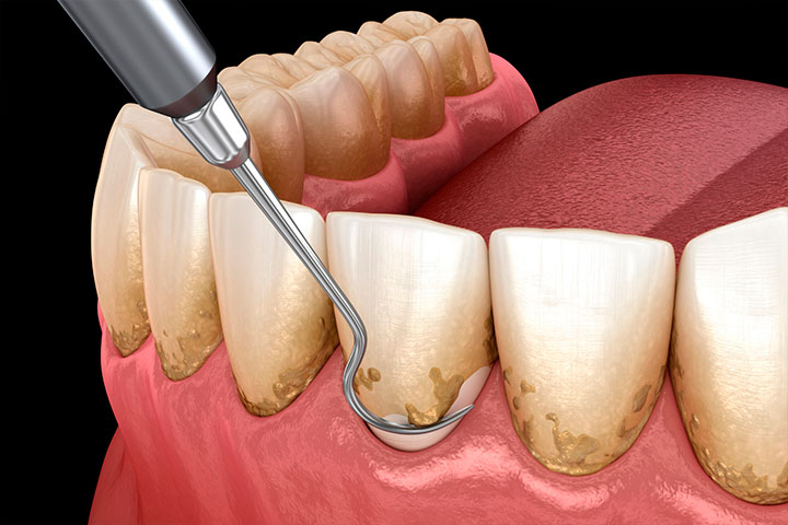 Periodoncia