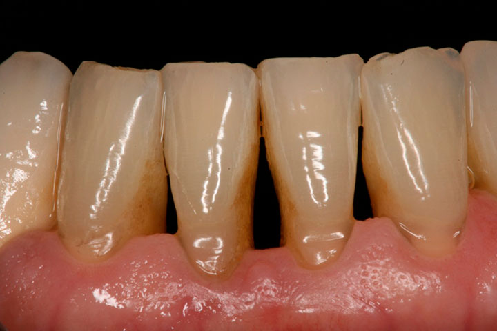 Periodontitis